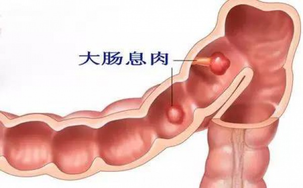 体检中发现胃肠息肉怎么办，切还是不切？九成肠癌由息肉转变而来